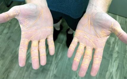 "Диета хищника" имела для мужчины шокирующие последствия: детали, фото